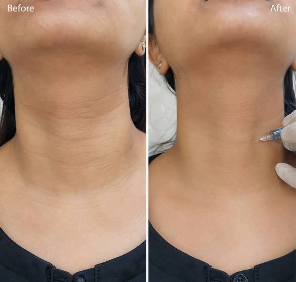 Neck-Lines-Treatment.png
