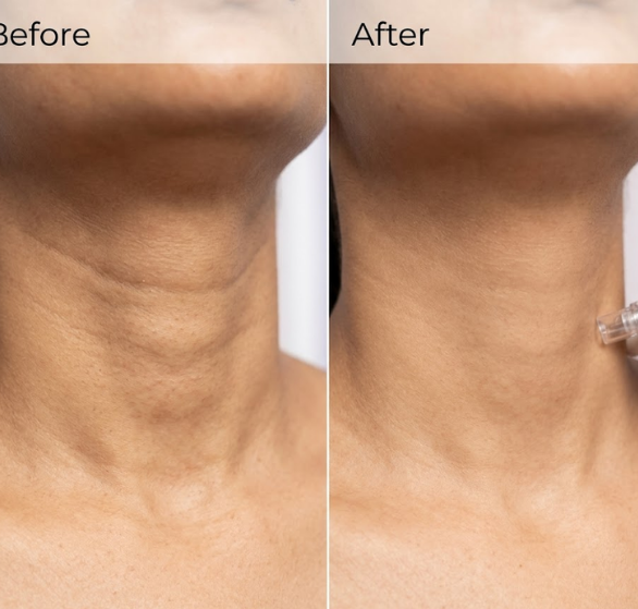 Neck-Lines-Treatment.png