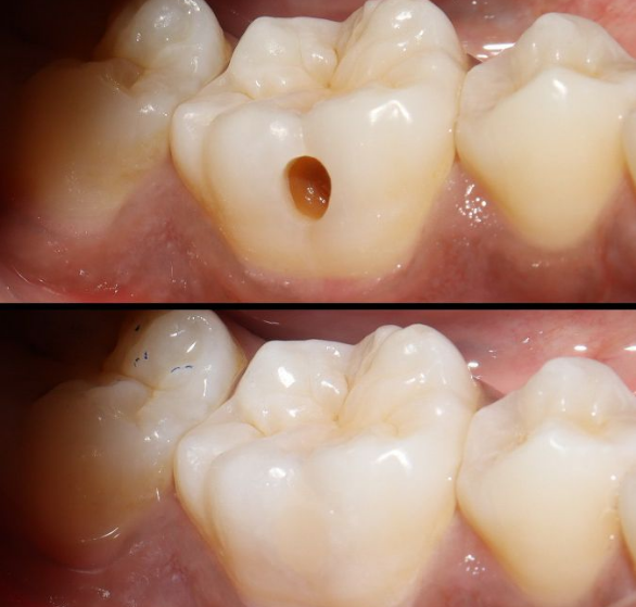 cavity-filling.png