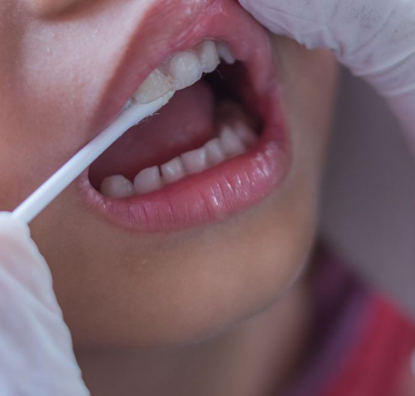 fluoride-treatment.png