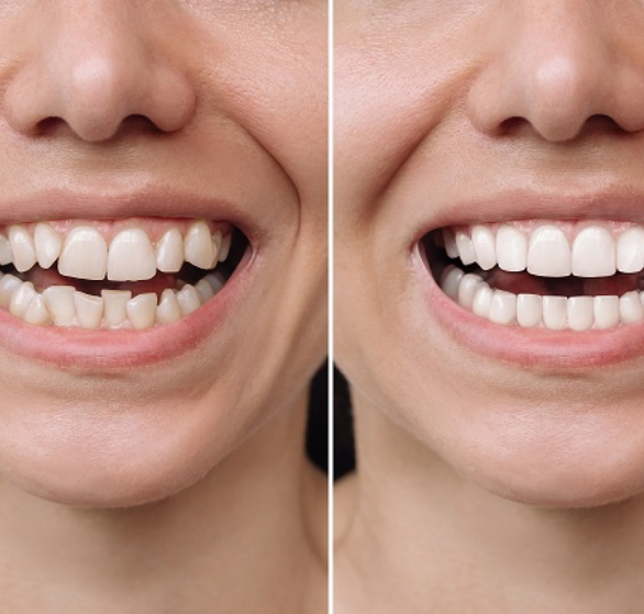 invisible-aligners.png