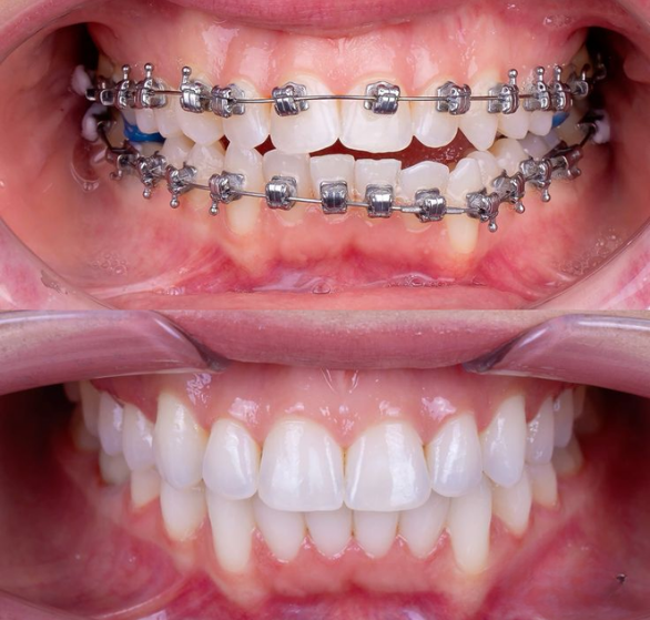 braces-treatment.png