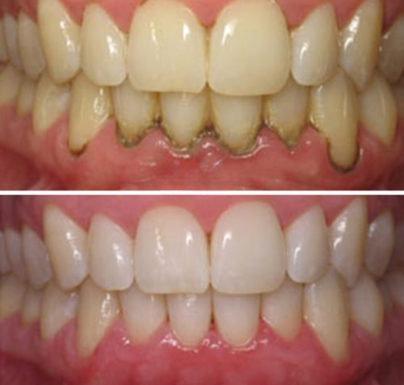 scaling-&-polishing-(teeth-cleaning).png