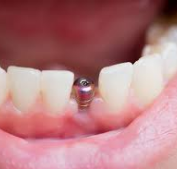 single-tooth-implant.png