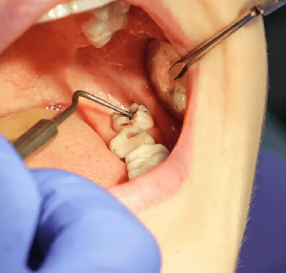 1-tooth-extraction.png
