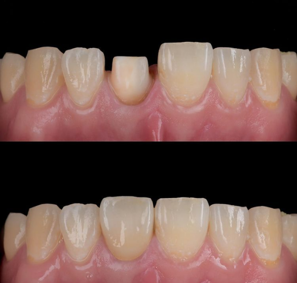 dental-crowns.png