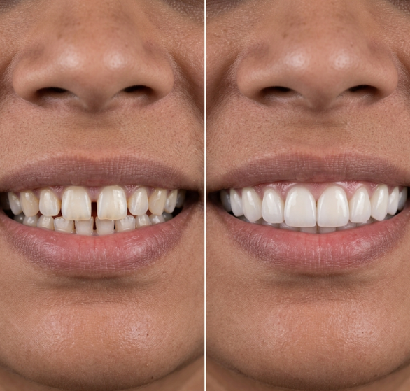 dental-veneers.png