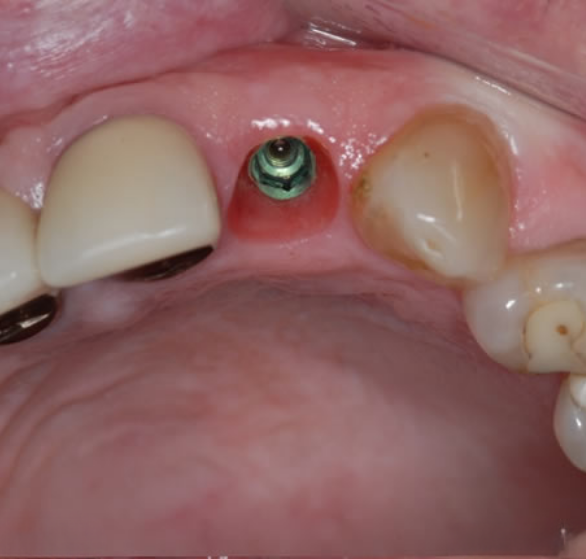single-tooth-implant.png
