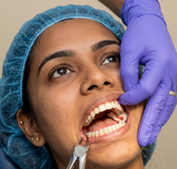 wisdom-tooth-removal.png