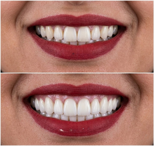 hollywood-smile-makeover.png