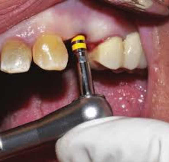 immediate-dental-implants.png