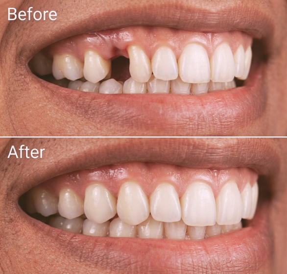 single-tooth-implant.png