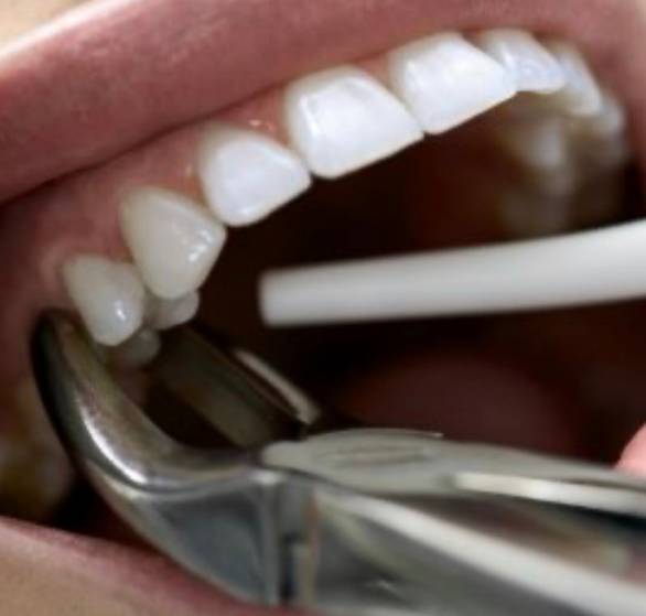 1-tooth-extraction.png