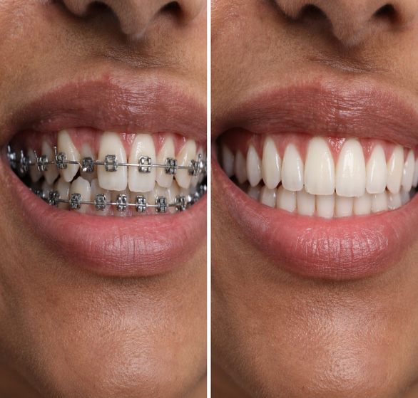 braces-treatment.png