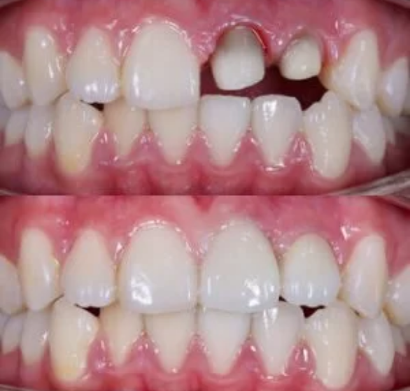 dental-crowns.png