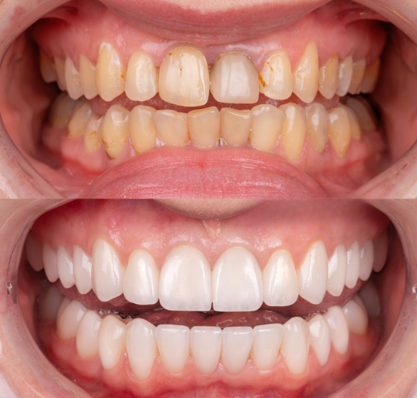 full-mouth-rehabilitation.png