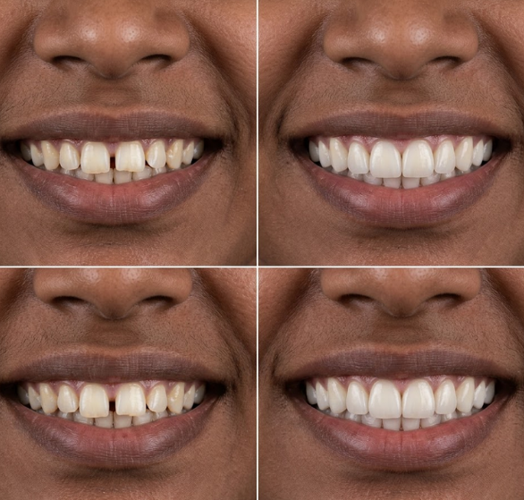 smile-designing.png