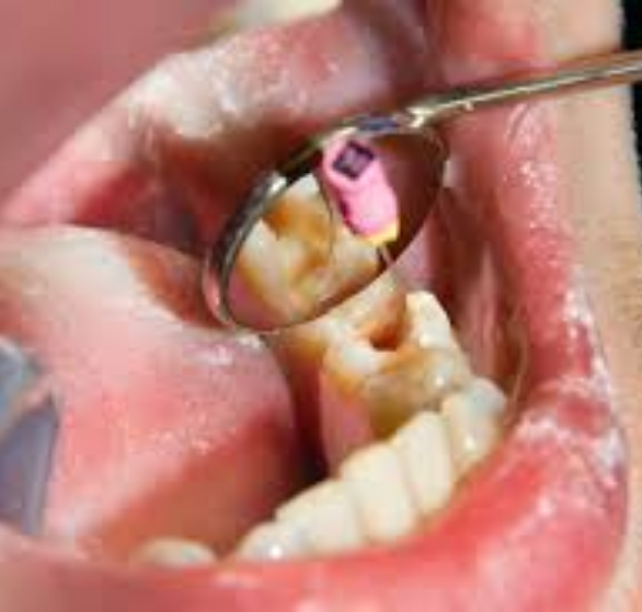 1-tooth-extraction.png