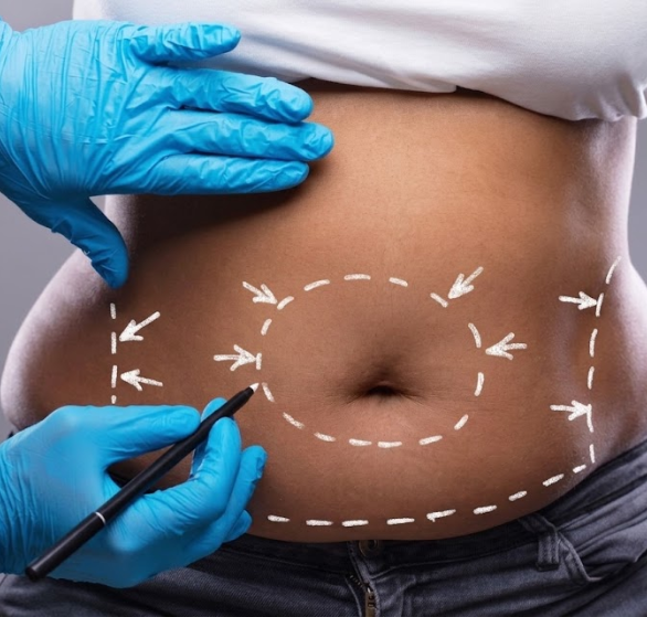abdominoplasty