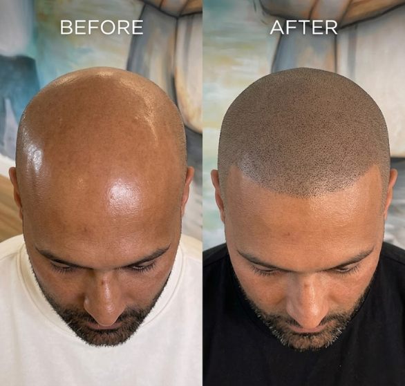 scalp-micropigmentation.png