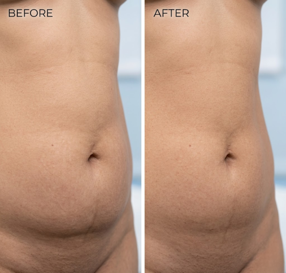 abdominoplasty