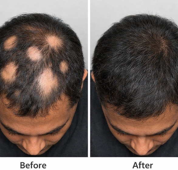 alopecia-areata.png
