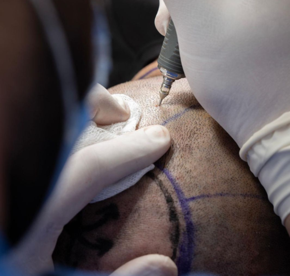autologous-micrograft-treatment.png