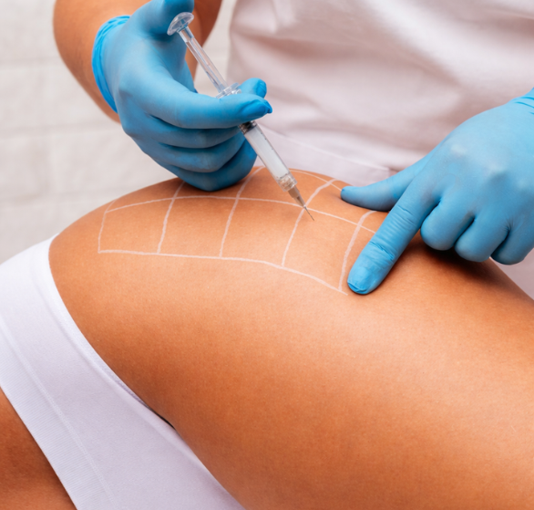 lipolysis-injections.png