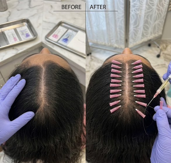 hair-thread-treatment.png