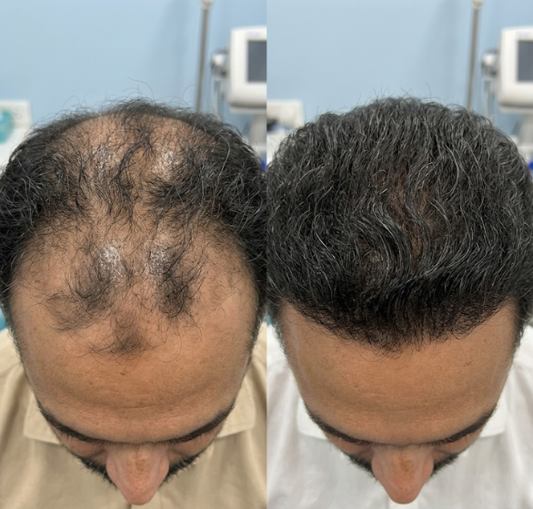 turban-traction-alopecia.png
