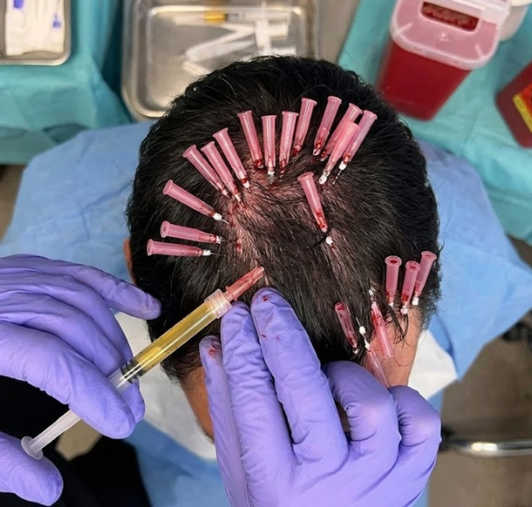hair-thread-treatment.png