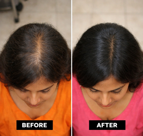 ozone-therapy-for-hair-strengthening.png
