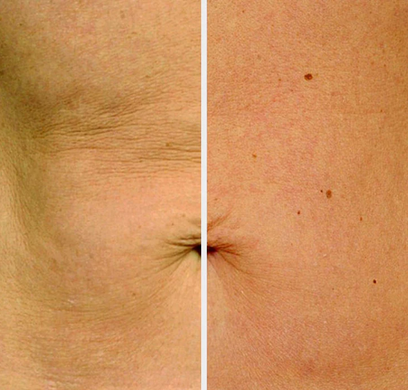viora-body-contouring.png