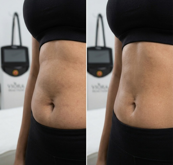 viora-body-contouring.png
