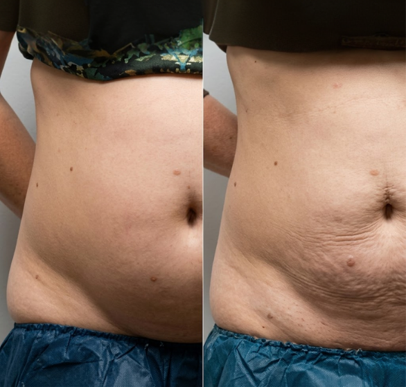 cryolipolysis.png